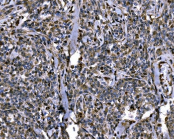 IHC staining of FFPE human lymphoma tissue with Importin subunit alpha-1 antibody. HIER: boil tissue