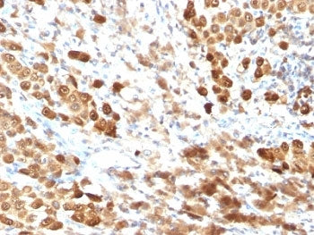 IHC testing of FFPE human melanoma with S100B antibody (clone SPM354). Required HIER: boil tissue se