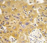 IHC testing of FFPE human hepatocellular carcinoma tissue with CAMK1 delta antibody. HIER: steam section in pH6 citrate buffer for 20 min and allow to cool prior to staining.