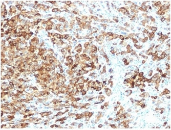 IHC staining of FFPE human melanoma tissue with recombinant PMEL17 antibody (clone rPMEL17/6821). HI