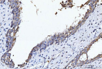 IHC staining of FFPE human breast cancer tissue with CYB5B antibody. HIER: boil tissue sections in p