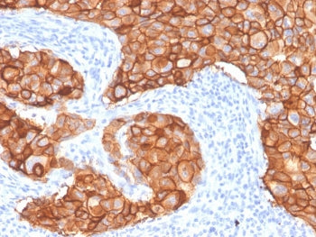 IHC staining of FFPE human breast carcinoma with HER2 antibody (clone ZR5). HIER: boil tissue sectio