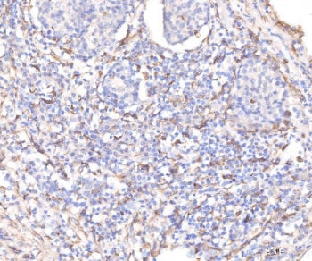 IHC staining of FFPE human lung cancer tissue with KCNQ1 antibody. HIER: boil tissue sections in pH8
