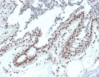 IHC staining of FFPE human breast carcinoma tissue with NM23 antibody (clone NME1/2738). HIER: boil 