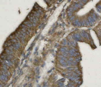 IHC staining of FFPE human rectal cancer with PHB2 antibody. HIER: boil tissue sections in pH8 EDTA 