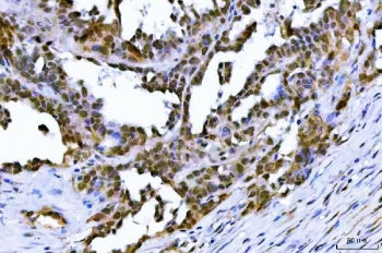 IHC staining of FFPE human ovarian serous adenocarcinoma tissue with TIF1 antibody. HIER: boil tissu