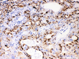 IHC testing of FFPE human liver cancer tissue with CYP3A4 antibody at 1ug/ml. HIER: steam section in