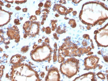 IHC staining of FFPE human thyroid carcinoma with TPO antibody. HIER: boil tissue sections in pH 9 1