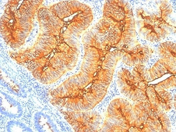 IHC: Formalin-fixed, paraffin-embedded human colon carcinoma stained with TAG-72 antibody (clone SPM
