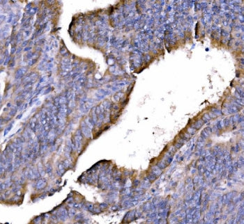 IHC staining of FFPE human rectal cancer tissue with GGA3 antibody. HIER: boil tissue sections in pH