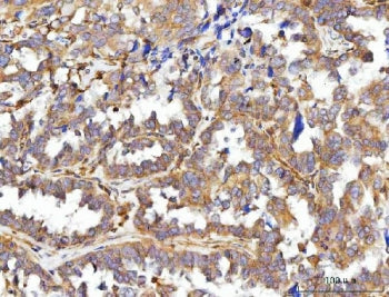 IHC staining of FFPE human ovarian cancer tissue with CCDC115 antibody. HIER: boil tissue sections i