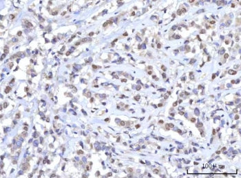 IHC staining of FFPE human breast cancer tissue with RANBP2 antibody. HIER: boil tissue sections in 