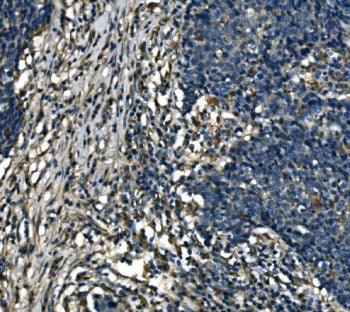 IHC staining of FFPE human lung cancer tissue with ATP6V1A antibody. HIER: boil tissue sections in p