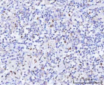 IHC staining of FFPE human testicular seminoma tissue with RAD51C antibody. HIER: boil tissue sectio