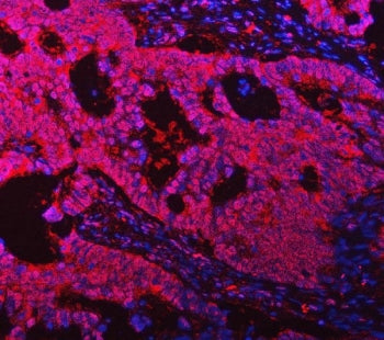 Immunofluorescent staining of FFPE human intestinal cancer tissue with TMS1 antibody (red) and DAPI 