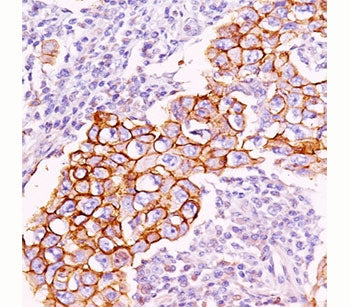IHC staining of breast carcinoma with phosphotyrosine antibody (PY20). Note cell surface and cytopla