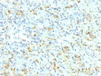 IHC staining of FFPE human Ewing Sarcoma tissue with recombinant Anaplastic Lymphoma Kinase antibody