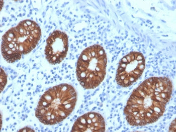 IHC staining of FFPE human colon carinoma with recombinant EpCAM antibody (clone rEGP40/4547). HIER: