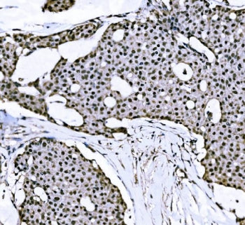 IHC staining of FFPE human papillary carcinoma of the breast with BTBD14B antibody. HIER: boil tissu