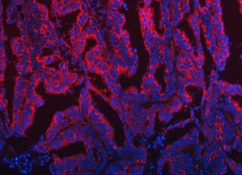 Immunofluorescent staining of FFPE human ovarian cancer tissue with TOM1L1 antibody (red) and DAPI n