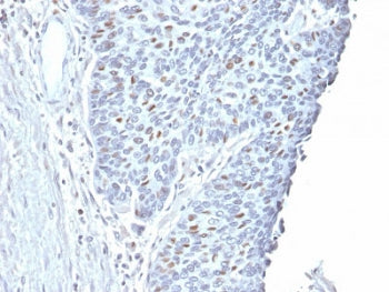 IHC testing of FFPE human endometrial carcinoma with Cyclin A2 antibody. Required HIER: steam sectio