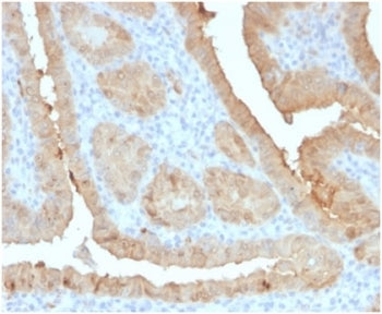 IHC staining of FFPE human thyroid carcinoma with LGALS3 antibody (clone LGALS3/4792). HIER: boil ti