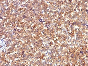 IHC: Formalin-fixed, paraffin-embedded human fetal liver stained with Alpha Fetoprotein antibody (C2