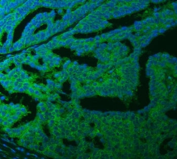 Immunofluorescent staining of FFPE human ovarian cancer tissue with Ferroportin 1 antibody (green) a
