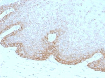IHC testing of human cervical carcinoma with FAT2 antibody (clone 8C5). Required HIER: boil tissue s