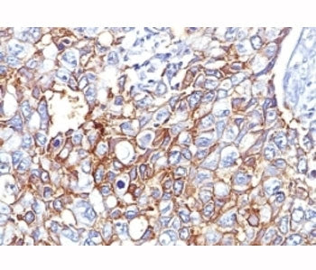 IHC: Formalin-fixed, paraffin-embedded human breast carcinoma stained with EpCAM antibody (EGP40/826