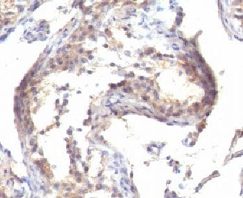 IHC testing of FFPE human testicular carcinoma with TGF alpha antibody