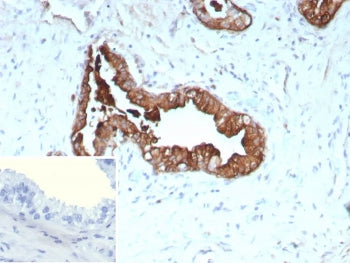 IHC staining of FFPE human prostate cancer tissue with recombinant KRT19 antibody (clone rKRT19/9108