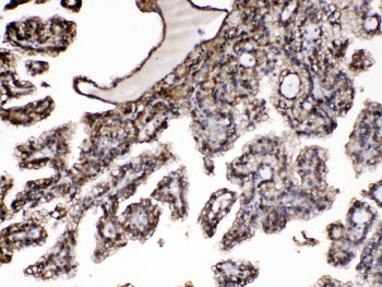 IHC testing of FFPE human renal cancer tissue with Purine nucleoside phosphorylase antibody at 1ug/m