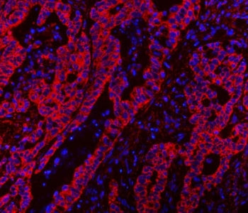 Immunofluorescent staining of FFPE human colorectal adenocarcinoma tissue with CLASP1 antibody (red)