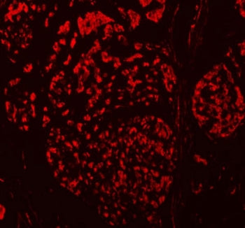 Immunofluorescent staining of FFPE human breast cancer tissue with TBX18 antibody (red). HIER: steam