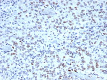 IHC staining of FFPE human Lynch disease colon with MutS homolog 2 antibody (clone MSH2/3165). HIER: