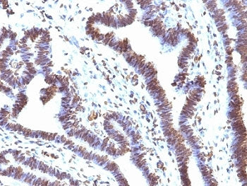 IHC: Formalin-fixed, paraffin-embedded human ovarian carcinoma stained with EMI1 antibody (clone EMI