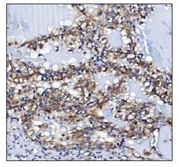 IHC staining of FFPE human renal clear cell carcinoma tissue with KCNQ2 antibody. HIER: boil tissue 