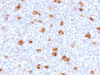 IHC staining of FFPE human Hodgkin's lymphoma with Bcl-X antibody (clone SPM519). HIER: boil tissue 