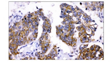 IHC staining of FFPE human ovarian cancer tissue with AMHR2 antibody. HIER: boil tissue sections in 