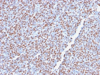 IHC testing of FFPE anaplastic large-cell lymphoma with recombinant ALK antibody (clone ALK1/2766R).