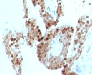 IHC testing of human prostate carcinoma and p57 antibody (clone KIP57-1). Staining of formalin-fixed
