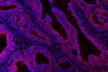Immunofluorescent staining of FFPE human colorectal adenocarcinoma tissue with HBEGF antibody (red) 