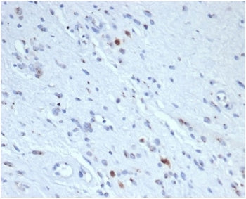 IHC staining of FFPE human rhabdomyosarcoma tissue with recombinant MYOG antibody (clone rMYOG/6297)