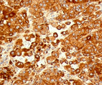 IHC testing of human melanoma stained with CD63 antibody (NKI/C3).