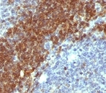 IHC analysis of formalin-fixed, paraffin-embedded human non-Hodgkin's lymphoma stained with anti-Bcl