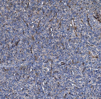 IHC staining of FFPE human skin cancer tissue with COL4A3 antibody. HIER: boil tissue sections in pH8 EDTA for 20 min and allow to cool before testing.