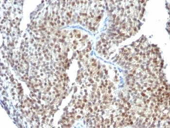 IHC: Formalin-fixed, paraffin-embedded human bladder carcinoma stained with Estrogen Receptor beta a