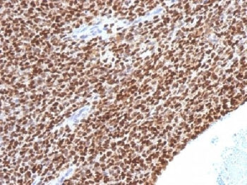 IHC testing of FFPE Ewings sarcoma with NKX2.2 antibody (clone NX2/1524). HIER: steam sections in 10