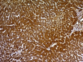 IHC: Formalin-fixed, paraffin-embedded human hepatocellular carcinoma stained with HepPar1 antibody 